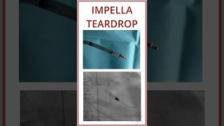 IMPELLA TEARDROP IN FLUOROSCOPY SCREW CONNECTION [upl. by Suruat]