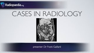 Cases in Radiology Episode 2 abdomen CT [upl. by Dobbins123]