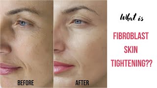 What is Fibroblast Skin Tightening [upl. by Anitnelav822]