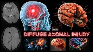 DIFFUSE AXONAL INJURYCASE OF THE MONTH [upl. by Safir]