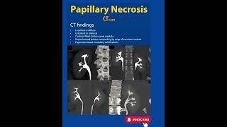 Papillary Necrosis  CT  Radiology [upl. by Bard]