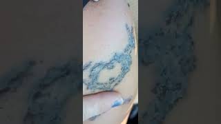 Healing process for Neatcell Blue Light Laser Tattoo Removal [upl. by Nelubez671]