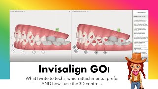 Invisalign GO ClinCheck amp case analysis [upl. by Eojyllib616]