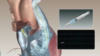 Swan Ganz catheter bolus thermodilution animation [upl. by Imit644]