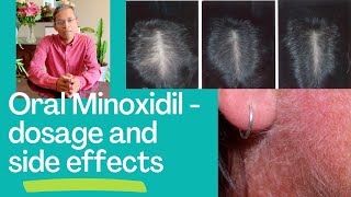 Oral Minoxidil for hair disorders  dosage and side effects [upl. by Held221]