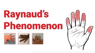 Raynaud’s Phenomenon  What You Should Know  Johns Hopkins Medicine [upl. by Cordey]