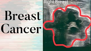 Breast Cancer  What Does Breast Cancer Look Like on an Ultrasound [upl. by Ives298]