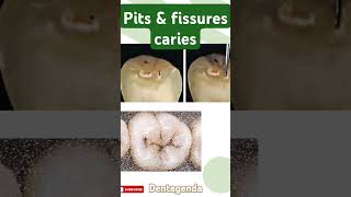 Pits amp fissure caries [upl. by Jenei860]