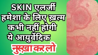 स्किन एलर्जी का घरेलू नुस्खा How To Cure Skin Allergy skin allergy treatment at home Dr Dharam Pal [upl. by Zilla435]