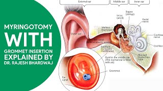 Myringotomy with grommet insertion by Dr Rajesh Bhardwaj ENT Specialist [upl. by White]