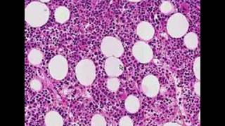 Histopathology Bone marrow Follicular lymphoma [upl. by Ainerol941]