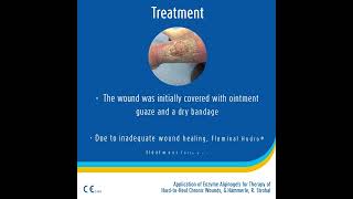 Case study  Leg Ulceration [upl. by Gombach]