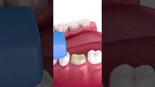 Dental crown indradentalvlogs shorts drrahultripathi dentalcrowns [upl. by Kane]