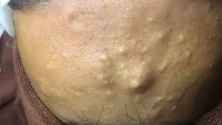 How to Remove Blackheads And Whiteheads On Face Easy Acne Treatment [upl. by Lemor]