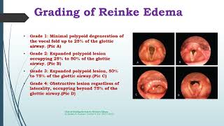 Reinke Edema [upl. by Eward]