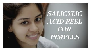 Salicylic Acid Peel For Pimplesdranvikacom [upl. by Eidoc]