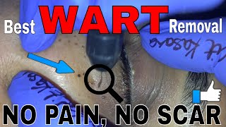 BEST WARTS REMOVAL [upl. by Ellehcan]