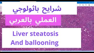 Cell Injury  Lipid Accumulation  Steatosis  Liver  Ballooning  Water Accumulation [upl. by Gluck]