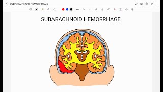 SUBARACHNOID HEMORRHAGE [upl. by Aiclid]