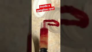 WHAT’S INSIDE A GANGLION CYST 😳🤯 shorts youtube [upl. by Ailefo]