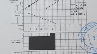 How to use a partograph step by step guide [upl. by Sorrows752]