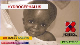 Hydrocephalus [upl. by Adamek]