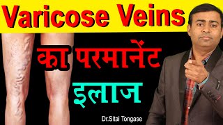 Varicose Veins का पर्मनंट इलाज cause symptoms treatment Homeopathic treatment [upl. by Garald]