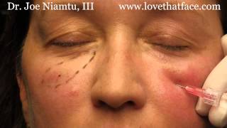 5 minute cheeks by Dr Joe Niamtu III [upl. by Avonasac]