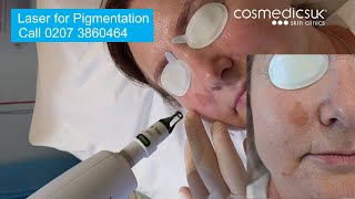 Laser for facial pigmentation amp sun damage treatment demo  see before and after results [upl. by Staten]