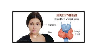 Hyperthyroidism Video No 606 [upl. by Nela]