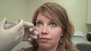 Juvéderm™ Tear Trough Treatment Huntsville Alabama  Dr David L Durst [upl. by Nairbo478]