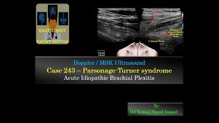 Ultrasound Case 243  Parsonage Turner Syndrome [upl. by Hoffmann]