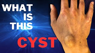 Wrist ganglion Cyst Learn to treat in 3 minutes [upl. by Viquelia519]