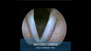 INYECCIÓN DE CUERDAS VOCALES  VOCAL FOLD INJECTION [upl. by Carilla]