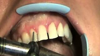 SMILE TRANSFORMATION  Porcelain Veneers  Part 1  Preparation [upl. by Naivaj]