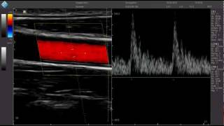 Carotide PWmp4 [upl. by Cyndi]