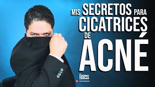 MIS SECRETOS PARA CICATRICES DE ACNE  DR MARINO DERMATOLOGO [upl. by Nahsaj902]