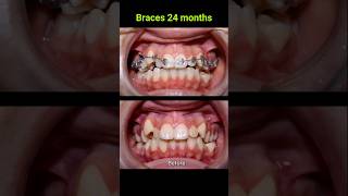 Braces correct all cases of crooked teeth braces orthodontist bracket [upl. by Whit]