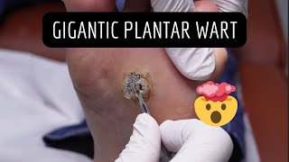 GIGANTIC Wart Removal Verruca Needling [upl. by Siuraj]