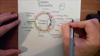 Diabetic Retinopathy Part 2 [upl. by Emsoc]