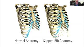 Slipping Rib Syndrome Functional Lower Rib Disorders and Abominal Vascular Compression Syndromes [upl. by Laeno]