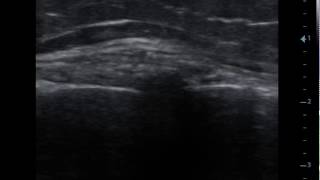 Entrapment of the infrapatellar branch of the Saphenous nerve non affected side [upl. by Acinad529]