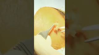 Cyst removal [upl. by Angelica]