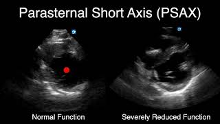 POCUS  Visually Estimating Cardiac Function [upl. by Evelunn]