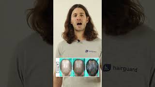 Minoxidil Gains  Boost its POWER  Part 2 Spironolactone for hair loss [upl. by Coussoule]