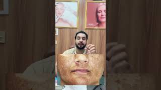 Is Laser Safe For Melasma  laser melasma pigmentation freckles skincare [upl. by Feerahs865]