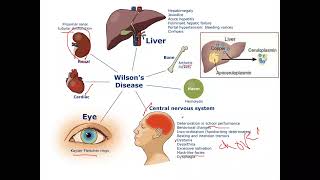 pediatric Hepatology Wilsons Disease [upl. by Novek]