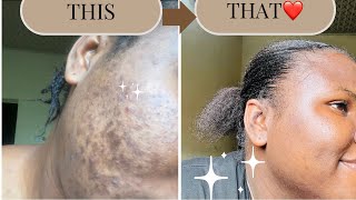 HOW I CLEARED MY HORMONAL ACNE  DARK SPOTS  HYPERPIGMENTATION FOR GOOD IN 1 MONTH [upl. by Jaclin]