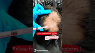 Alopecia areata treatment  Dr Sanchika Gupta 👩‍⚕️ [upl. by Abbate]