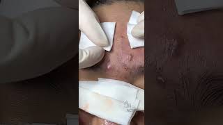 Inflamed Acne and Blackhead Removal CloseUp [upl. by Androw]